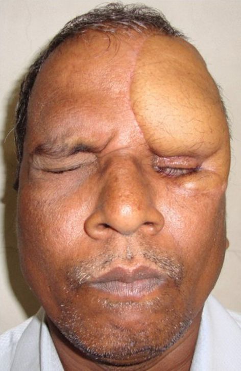Пересадка кожи бедра на лицо (5 фото)