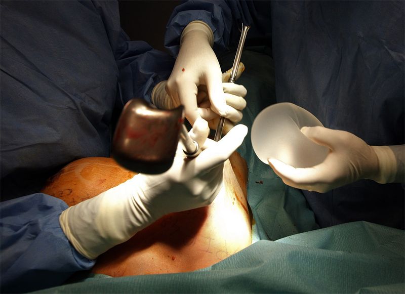 Операция по замене некачественных грудных имплантов PIP (12 фото)