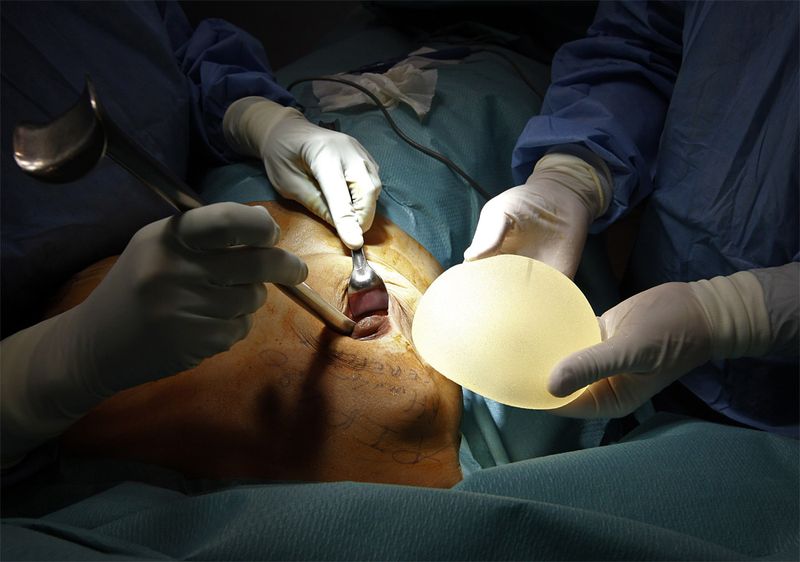 Операция по замене некачественных грудных имплантов PIP (12 фото)