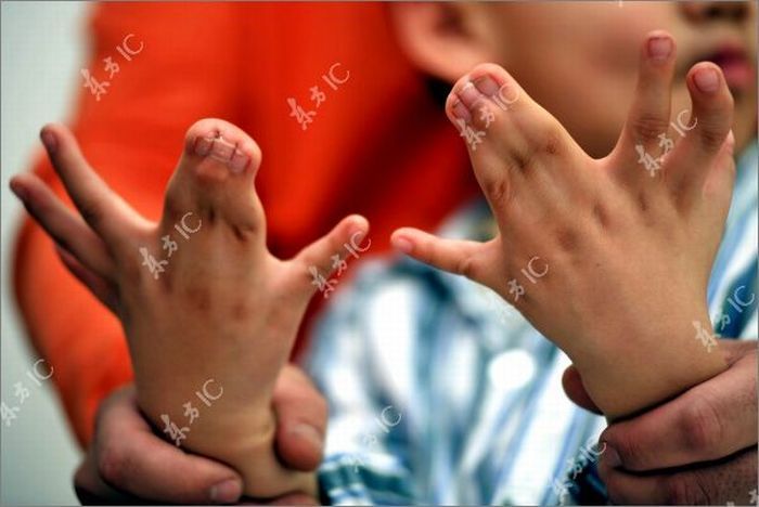 Китайский мальчик с 30-ю пальцами на руках и ногах (13 фото)