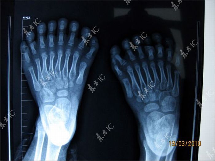 Китайский мальчик с 30-ю пальцами на руках и ногах (13 фото)
