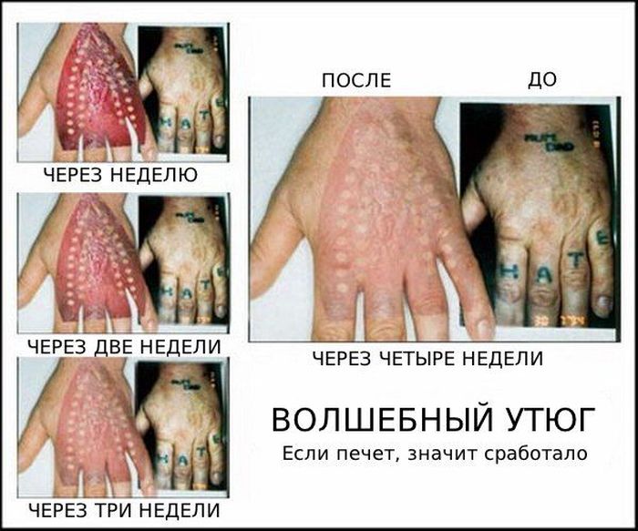 Удаление татуировки утюгом (1 фото)