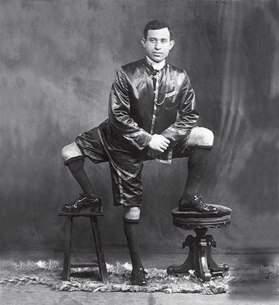 3 нога где. Франческо Лентини, человек с тремя ногами (фото)