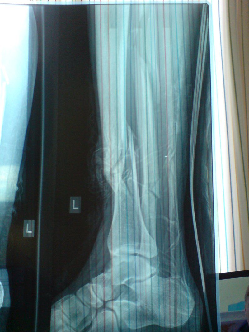 Открытый перелом ноги ( 5 фото)