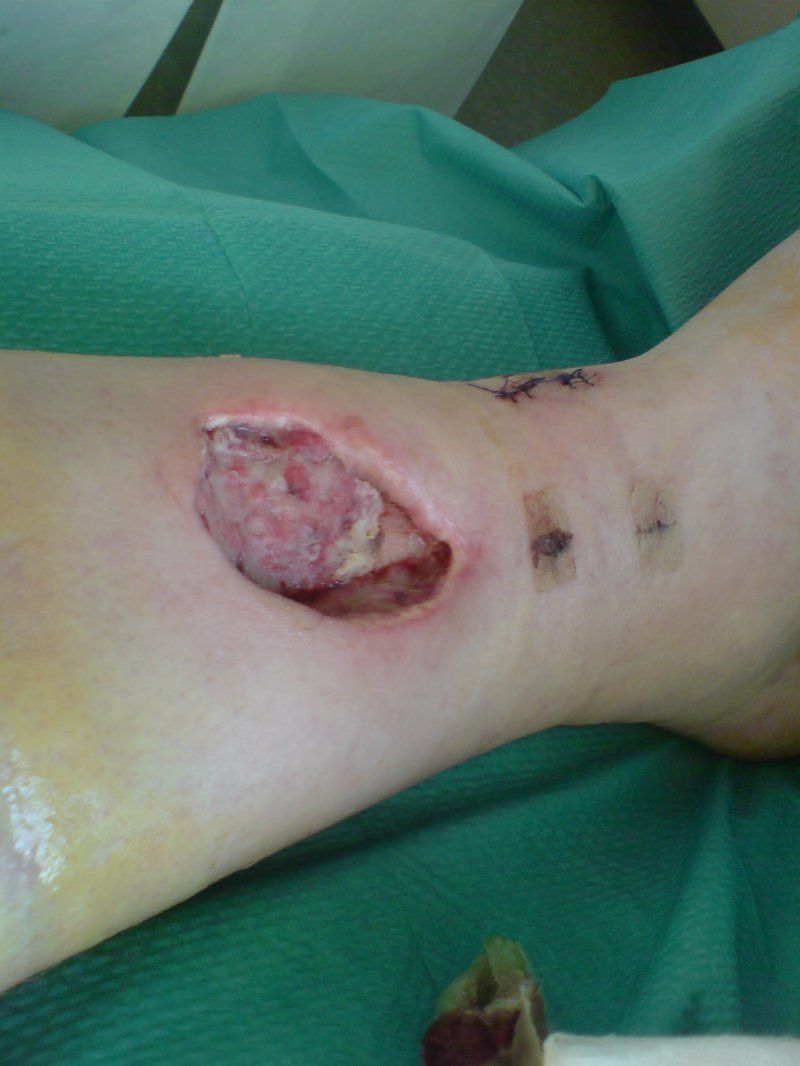 Девушка с открытым переломом ноги фото thumbnail