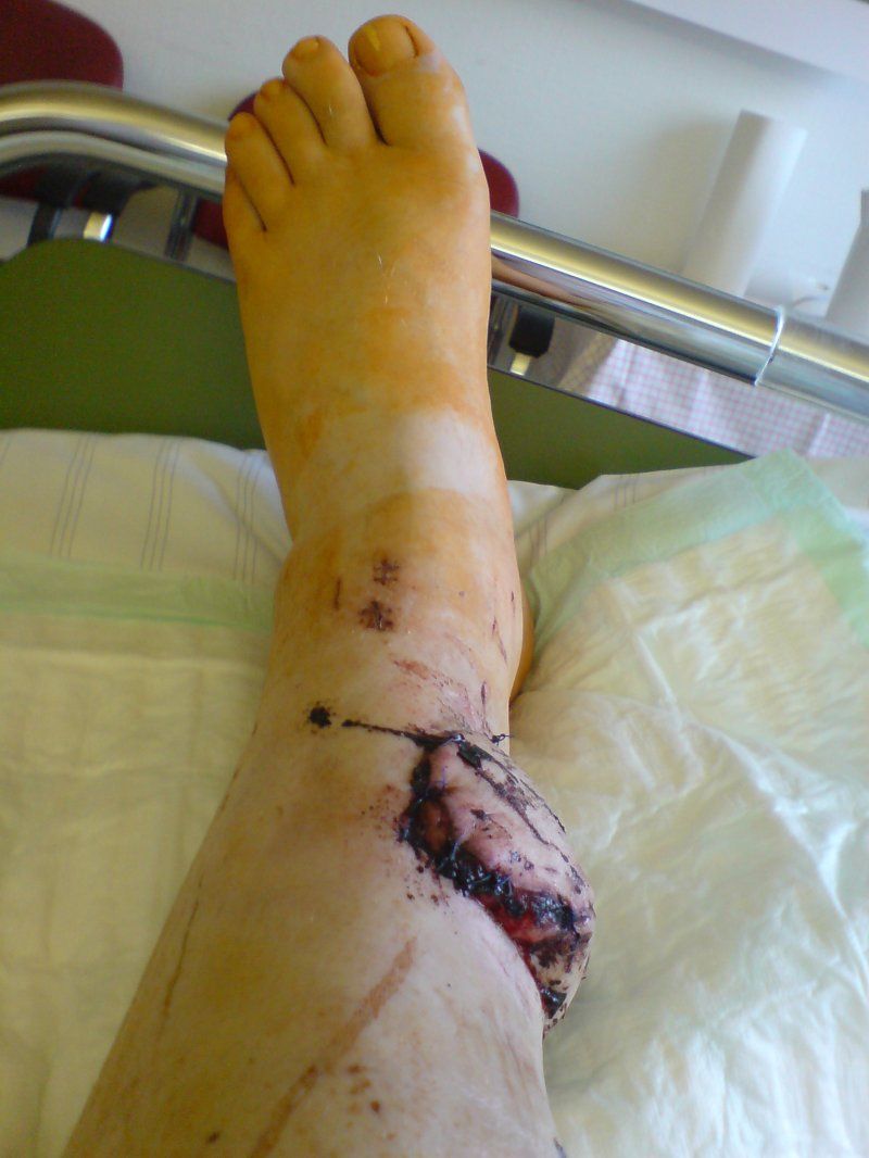 Открытый перелом ноги ( 5 фото)