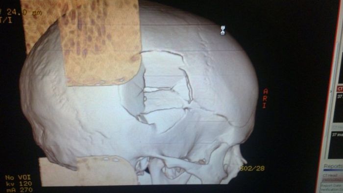 Мужик проломил себе череп (6 фото)