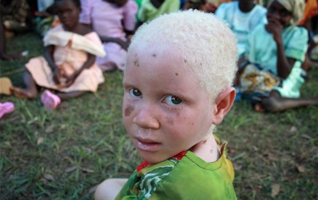 Альбиносы в Африке (8 фото)