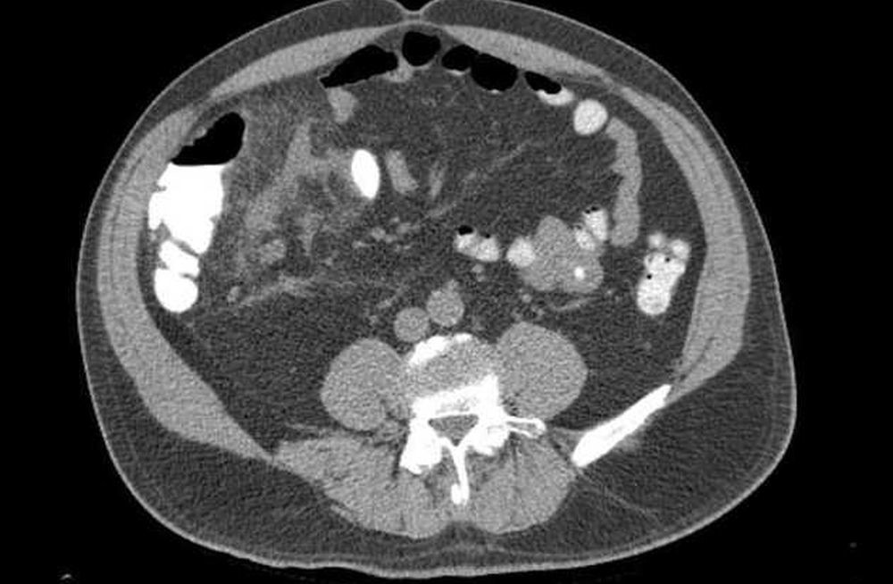 Острый аппендицит при весе 160 кг 